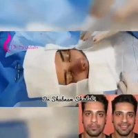 فیلم عمل جراحی بینی مردانه (قسمت دوم)
