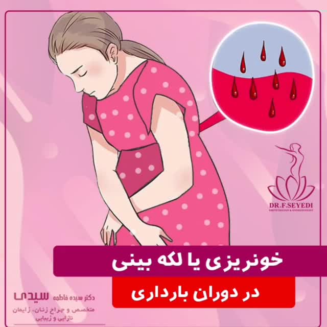 علت خونریزی یا لکه بینی در دوران بارداری