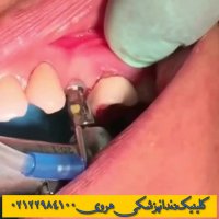 کاشت ایمپلنت دندان | نحوه بستن پیچ ایمپلنت دندان