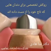 ترمیم تاج دندان | دکتر ندا هادی