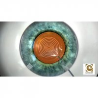 فیلم روش جراحی فمتو کاتاراکت