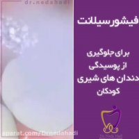 فیشورسیلانت