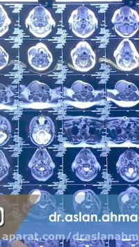 جراحی کیست اپیدرمال وسیع گردن