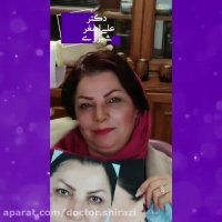 فیلم باز کردن گچ بینی و تغییرات بعد عمل