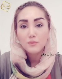 فیلم کاشت ابرو کلینیک تخصصی رنسانس