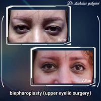بلفاروپلاستی پلک بالا | دکتر شهریار یحیوی