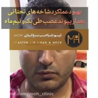 جراحی پیوند عصب