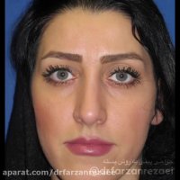 فیلم جراحی زیبایی بینی و تزریق چربی به زاویه فک