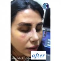 فیلم برداشتن گچ بینی بعد از عمل بینی و رضایت بیمار