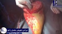 جراحی بدون سانسور تعویض مفصل زانو