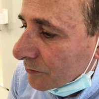 کاشت مو | کلینیک تخصصی رنسانس  02122088210