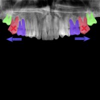 هدایت رویشی دندان های عقل | دکتر داودیان