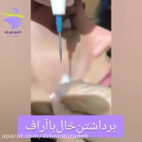 برداشتن خال با آر اف