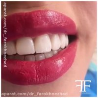 لمینت دندان