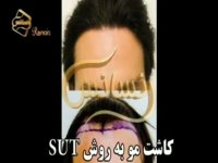 کاشت مو به روش SUT مرکز مو رنسانس