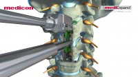 MEDICON - "mediExpand®" -Cervical