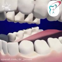 برداشت پوسیدگی و ترمیم همرنگ دندان