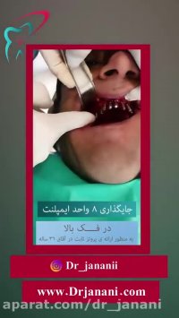 جايگذاري ٨ واحد ايمپلنت در فك بالا