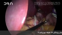 فیلم عمل جراحی لاپاراسکوپی اسلیو معده
