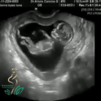 حرکت جنین در رحم