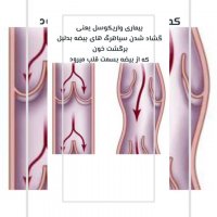 علت ابتلا به بیماری‌‌ واریکوسل و درمان قطعی آن بیماری