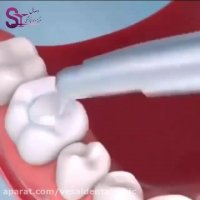 ترمیم کامپوزیت