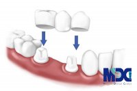 روکش دندان پلی یا بریج شده