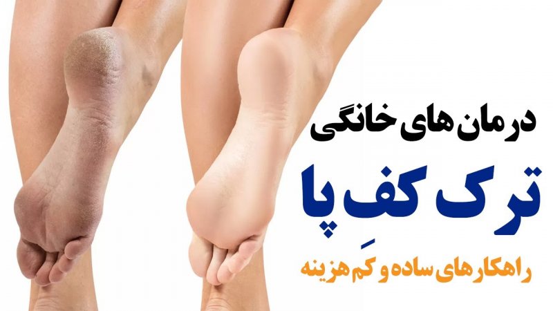 درمان های خانگی ترک کف پا