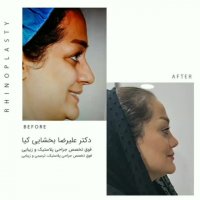 عمل بینی در سنین بالا به صورت فانتزی