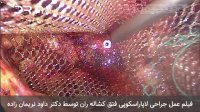 فیلم عمل جراحی فتق کشاله ران با روش لاپاراسکوپی
