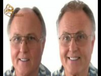 ترمیم مو به روش HRT  مرکز تخصصی مو رنسانس