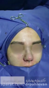 جراحی بینی طبیعی