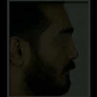 فیلم جراحی بینی شکسته