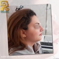 نتیجه جراحی رینوپلاستی پس از سه هفته