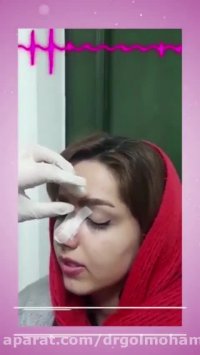 فیلم نحوه چسب زدن به بینی