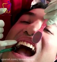 فیلم لمینت دندان | دکتر ندا هادی