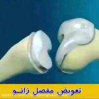 انیمیشن تعویض مفصل زانو