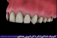 مقایسه درمان ایمپلنت و بریج