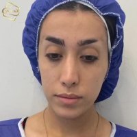 کاشت ابرو | کلینیک تخصصی رنسانس  02122088210