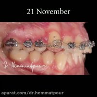 درمان نیش بیرون زده با ارتودنسی ثابت | دکتر سیامک همت پور