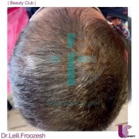 بهبود رویش مو با کربوکسی تراپی