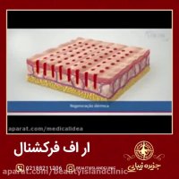 مراحل انجام آر اف فرکشنال روی پوست در قالب انیمیشن