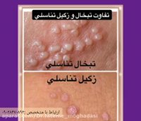 عکس های زگیل تناسلیHPV و تبخال تناسلیhsv