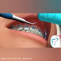 جراحی فرنکتومی