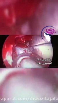 ❌جراحی ادنوم بینی بیمار از طریق بینی