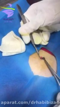 جراحی خال ناحیه شکم