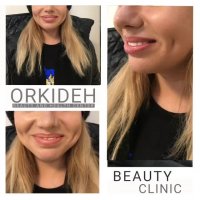 چال گونه در کلینیک ارکیده