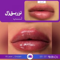 تزریق ژل لب در کلینیک ارکیده