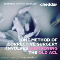 جراحی بازسازی رباط صلیبی