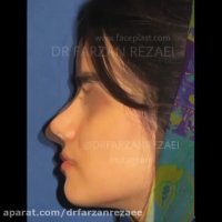 جراحی بینی نیمه فانتزی به روش بسته